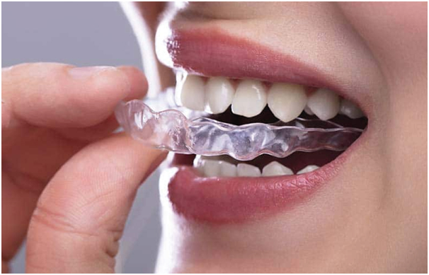 Bite dentale: tutto quello che devi conoscere