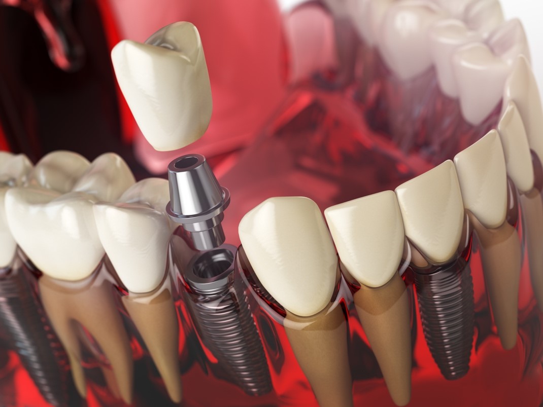 Pro e Contro impianti dentali