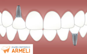 Quanti e Quali Tipi di Impianti Dentali